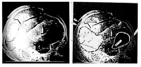 Official X-ray on the left and the patch Area P on the right ... which bears a striking correspondence in size and shape to the image in Frame 374...